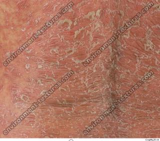 photo texture of scarred skin 0003